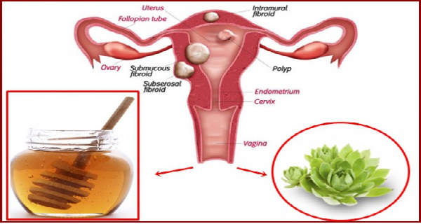 THE-MIXTURE-OF-THESE-2-INGREDIENTS-KILLS-CYSTS-AND-FIBROIDS