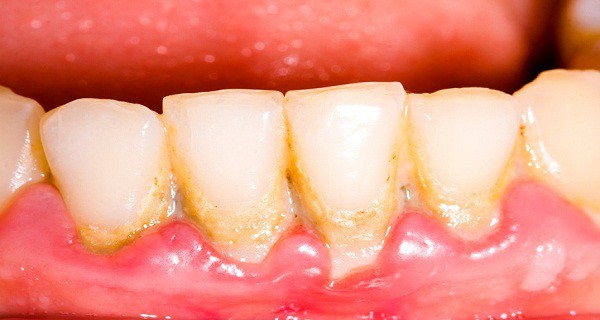 whiten-your-teeth-and-clean-plaque-with-just-one-ingredient-600x320
