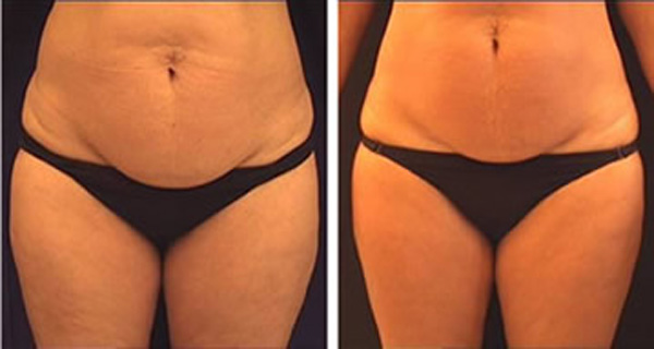 The-Secret-Recipe-For-a-Drink-That-quickly-Melt-Cellulite