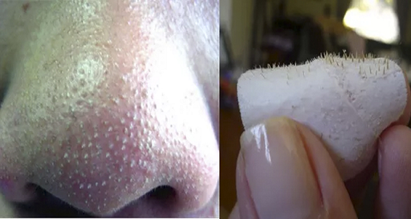 How-To-Get-Rid-Of-Blackheads-On-Nose-Fast-At-Home
