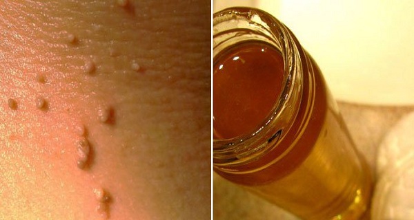 Remove-fibroma-or-skin-warts-very-easy