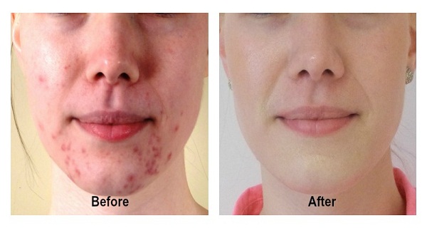 Make-Acne-And-Pimples-Disappear-Forever-In-14-Days