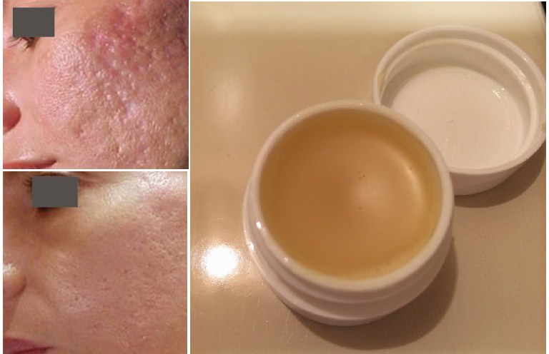 unique-homemade-cream-to-gets-rid-of-scars-completely-within-2-weeks