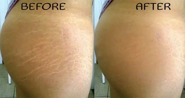 How-to-Remove-Stretch-Marks-Naturally-Within-6-Weeks