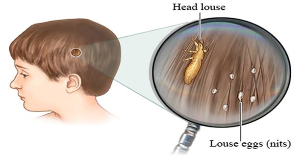 Doctors-Won’t-Tell-You-This-–-Cheap-Way-To-Get-Rid-Of-The-Head-Lice-Almost-Instantly